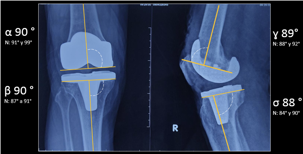 Clinico radiological Results In The Alignment Of Prosthetic Components 